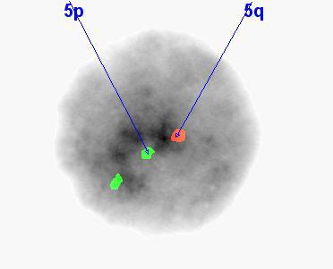 Figure 7: FISH with del(5q)